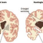 عکس بیماری هانتینگتون