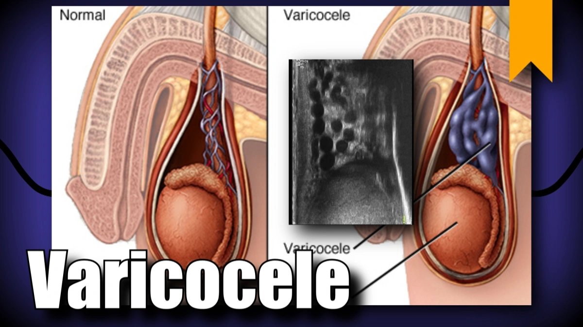 درمان واریکوسل چیست 