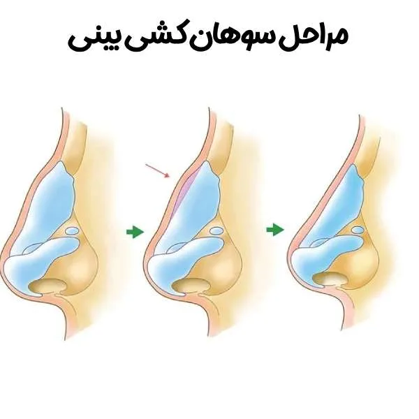 سوهان کشی بینی چیست و چگونه انجام می‌شود؟