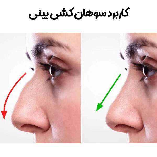 سوهان کشی بینی چیست و چگونه انجام می‌شود؟ 